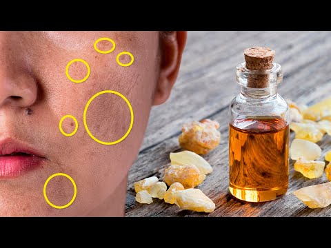 How to Remove Age Spots with Frankincense