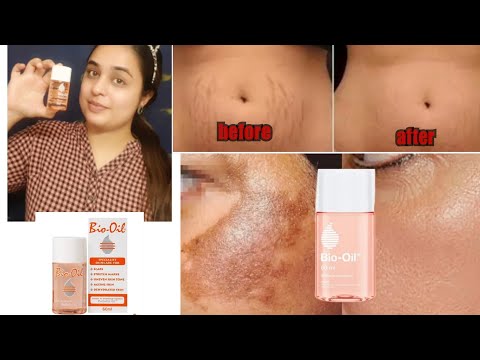 Bio oil : best for dry skin?/ स्ट्रेच मार्क्स का